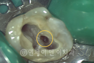숨은 신경관 확보