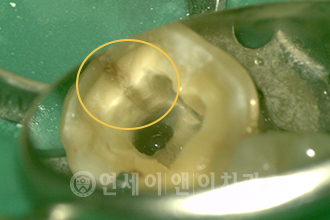 치아 균열선 확인