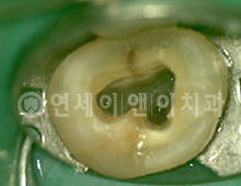 미세현미경 정밀 진단 치아 균열