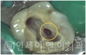 숨은 신경관 확보