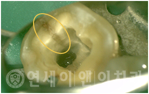 치아 균열 확인